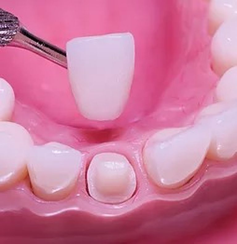 Dental Crowns Diley Ridge Dental Dental Crowns Diley Ridge Dental